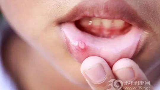 冬季“干燥上火”導致口腔潰瘍？四個細節(jié)要注意